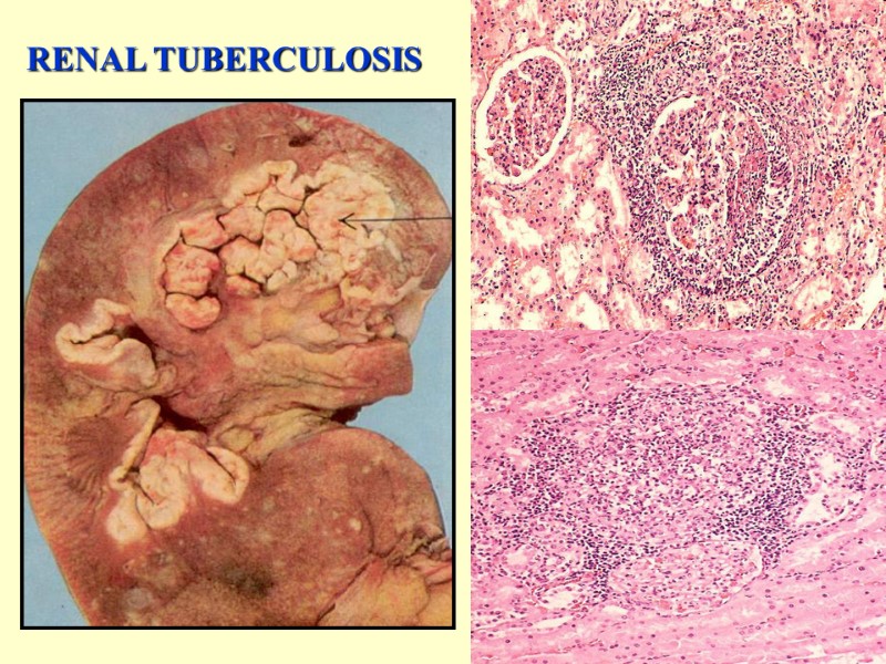 RENAL TUBERCULOSIS 39